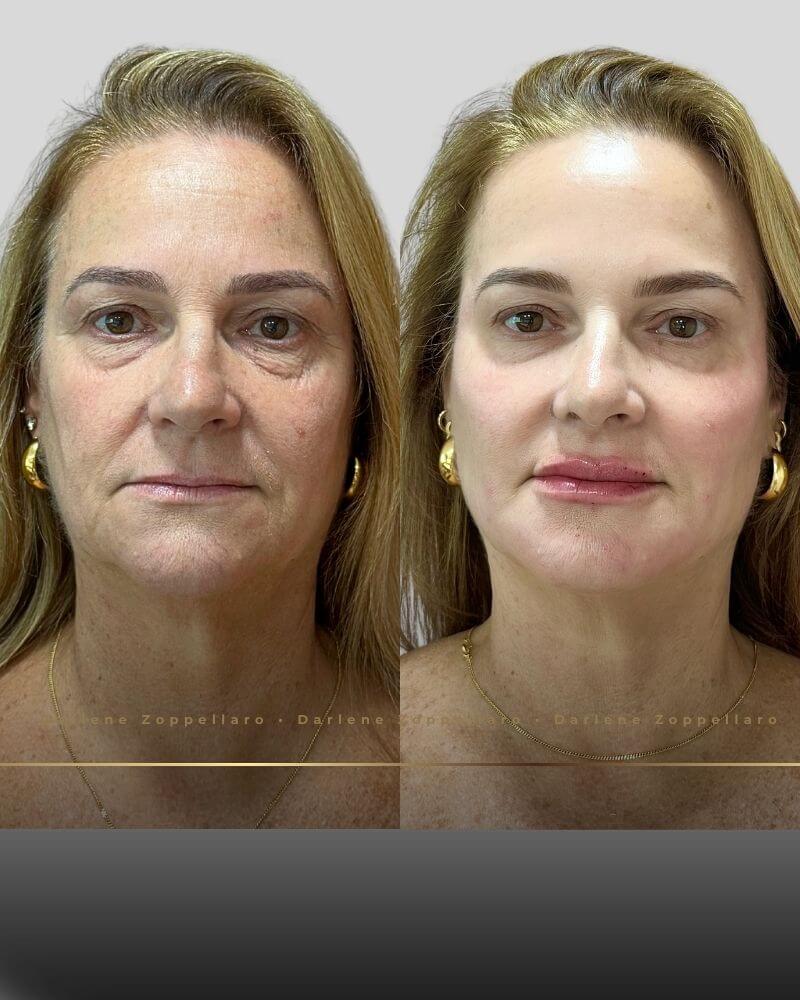Resultado de Toxina Botulínica