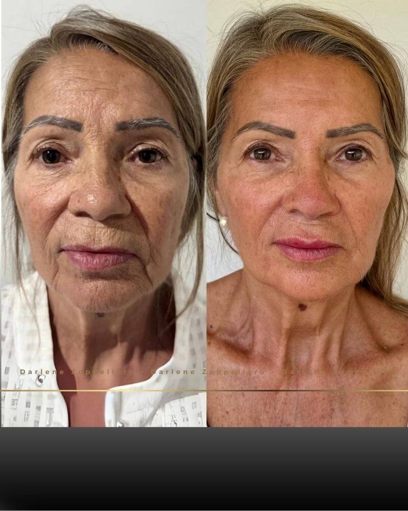 Resultado de Preenchimento